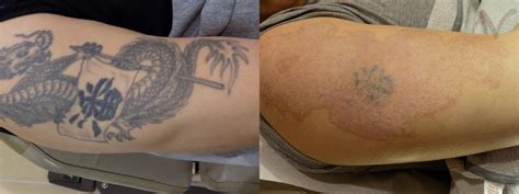 See Her Getting Laser Tattoo Removal Treatment by Dr