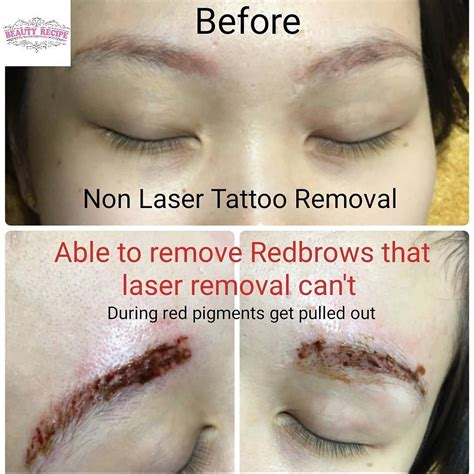 Laser Tattoo Removal Eyebrows