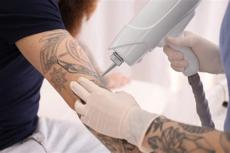 5 Frequently Asked Questions About Laser Tattoo Removal