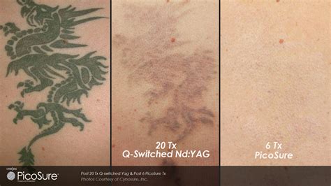Laser Ink PicoSure Laser Tattoo Removal Specialists
