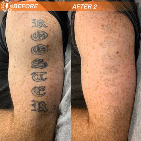 Tattoo removal before and after photos from Fresh Start