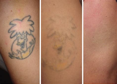 Tattoo Removal Treatment Laser