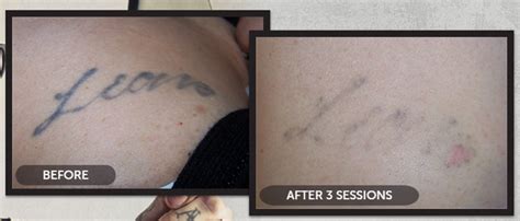 Laser Tattoo Removal Specialist Munster, IN N. Hasan