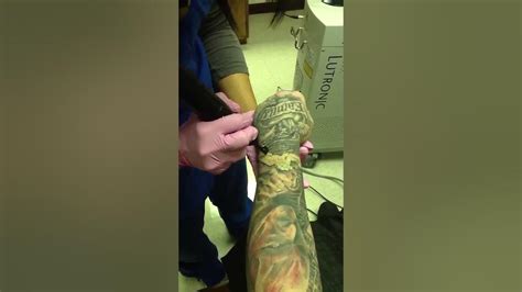 Laser Tattoo Removal Statistics From Skin Care Experts