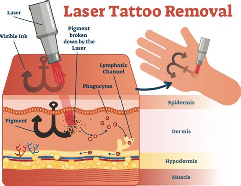 Fast Facts about Laser Tattoo Removal