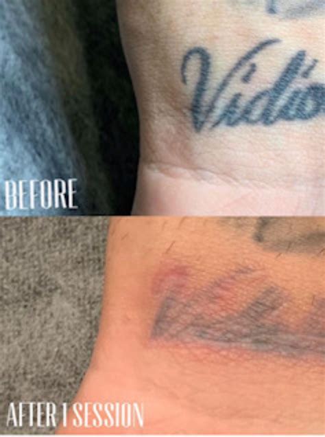 BeforeAfterTattooRemovalResults2019 InkAway Laser