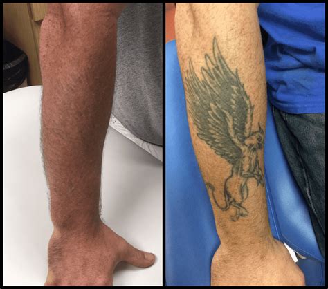 Laser Tattoo Removal Richmond, VA Travis Shaw, MD