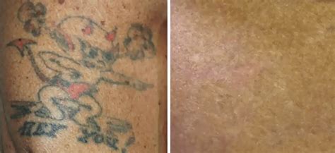 Medermis Tattoo Removal San Antonio Tx Laser Tattoo