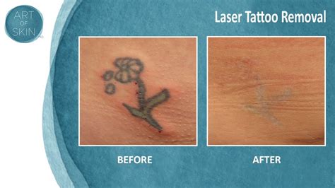 Tattoo Removal San Diego, CA Cosmetic Laser Dermatology