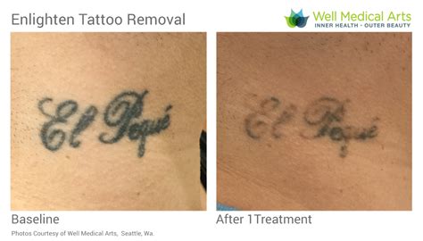 Tattoo Removal Well Medical Arts Seattle's AntiAging
