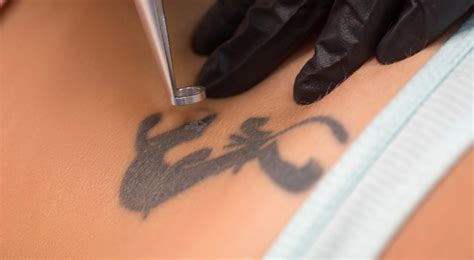 2 Day Laser Tattoo Removal Training Course Minnesota