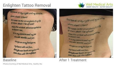 Laseraway Tattoo Removal Cost