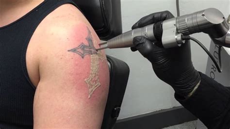 TattooRemovalWithLaserTechnology Tattoo Removal