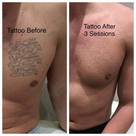 Laser Tattoo Removal the latest in effective tattoo removal.