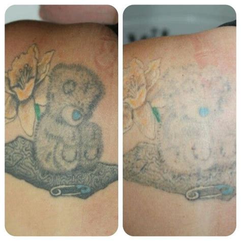 Tattoo Supplies Non Laser Tattoo Removal Before And After