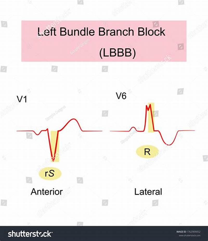 Left Bundle Branch Pattern