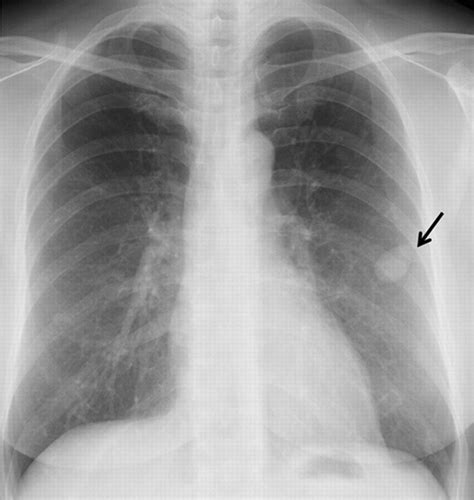Left Lung