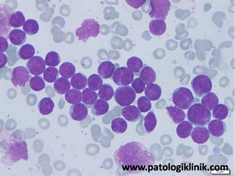 Leukemia Limfoblastik Akut L2 (ALLL2) Patologi Klinik