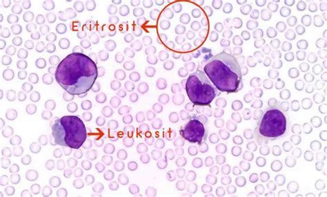 Leukosit: Normal, Tidak Normal & Cara Sehatnya