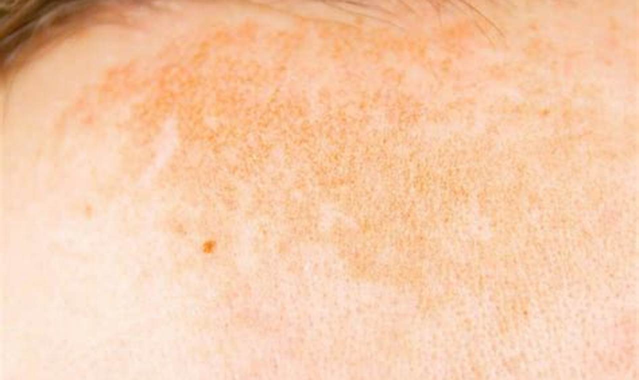 Light Brown Patches On Skin