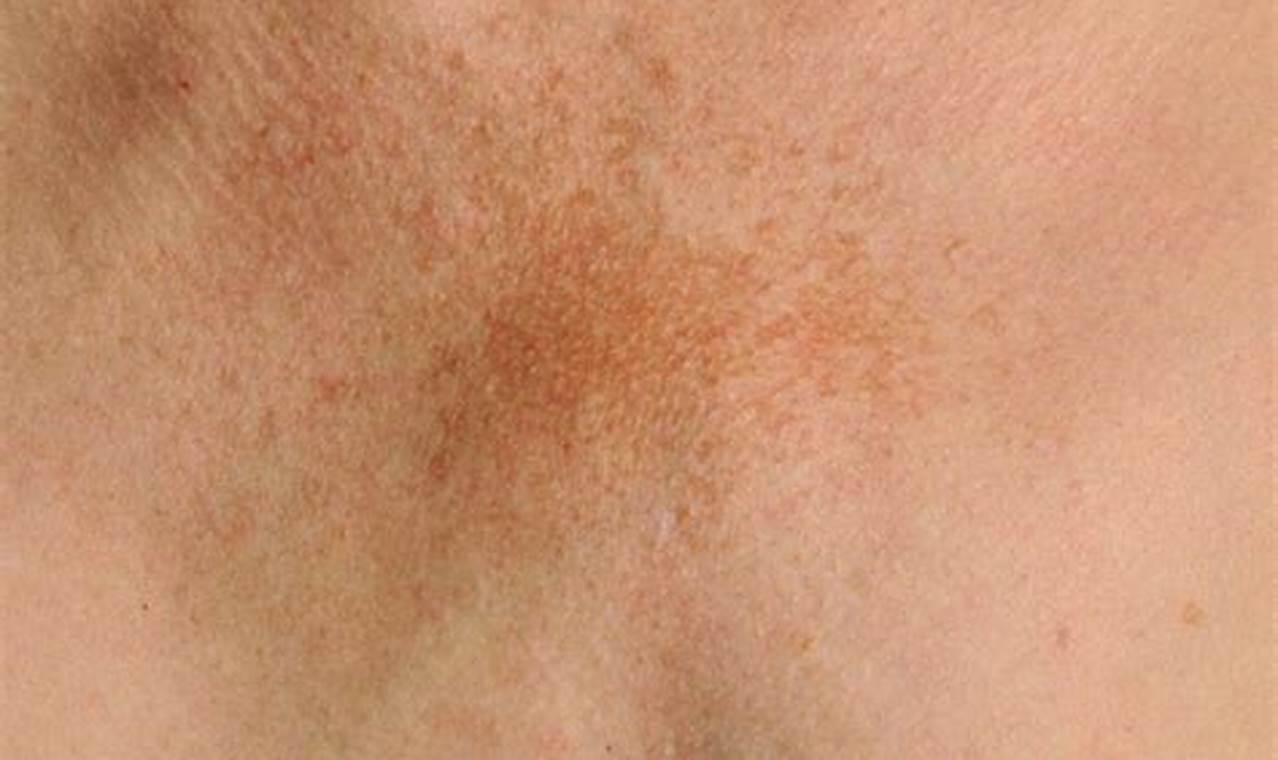 Light Brown Spots On Breast