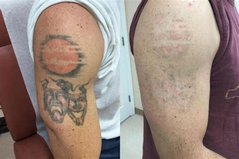 Laser Tattoo Removal Main Street Skin Clinic