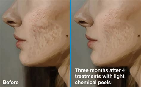 Light Chemical Peels: The Weekly Refresh