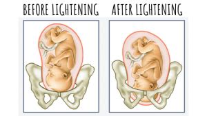 Expecting Mothers Beware: Shedding Light on Lightning During Pregnancy