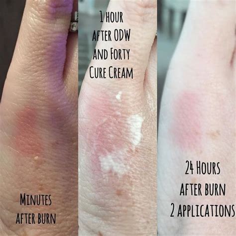 Lime Powder Burns on Skin: Unveiling the Reality of this Astringent Agent To Your Skin Health