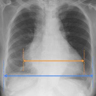 Limitations of a Chest X-Ray