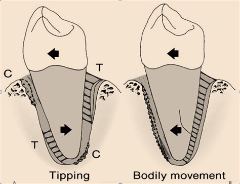 Limited Tooth Movements