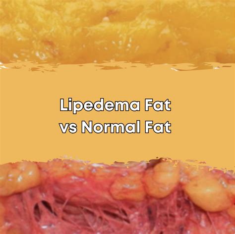 Lipedema vs. Normal Fat: Spotting the Difference & Finding Relief