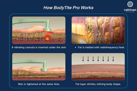 Sculpt Your Dream Body: Harness the Power of Liposuction and Skin Tightening to Achieve Flawless Contours!