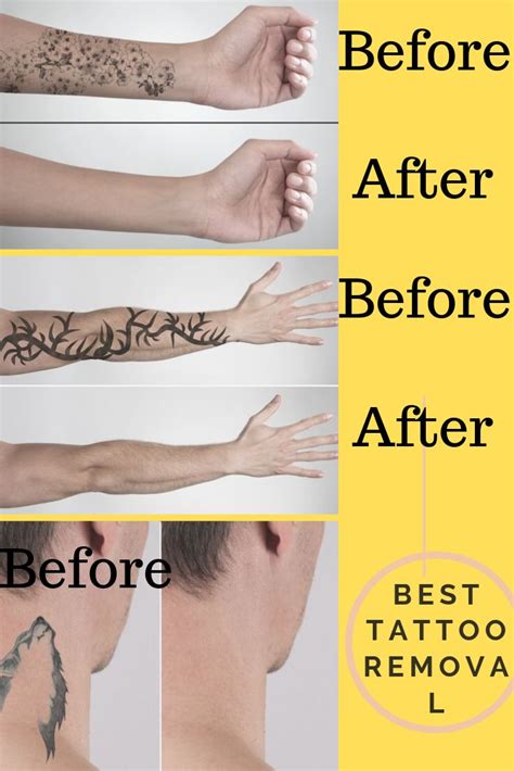 Laser Tattoo Removal Rejuvie Clinic