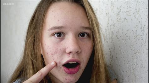 Teenage acne linked to success later in life