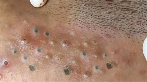 Experience the Ultimate Pimple Popping with Loan Nguyen's Latest Videos for 2022