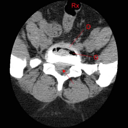 Sciatique ou Cruralgie, et Hernie Discale Lombaire - Hôpital Privé d