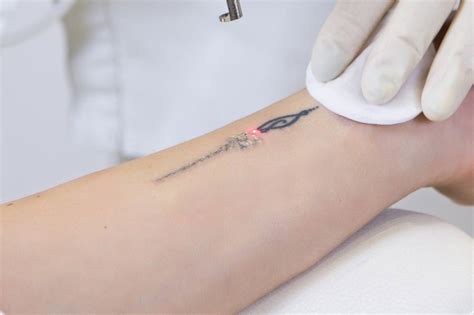 Tattoo Removal London Foot Tattoo Removal Before And