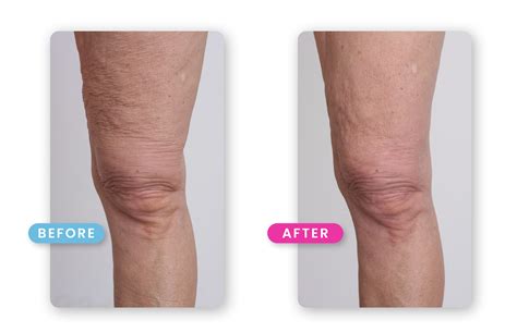 Transform Your Confidence: Say Goodbye to Loose Skin on Your Legs for Good!