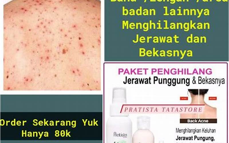 Lotion Terbaik Untuk Menyembuhkan Jerawat Di Punggung