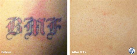 Before & After Photos Louisville KY Take It Off Laser
