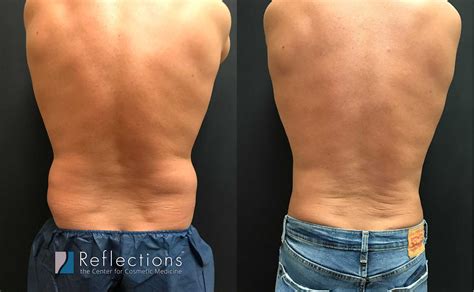 Love Handles Before And After Men
