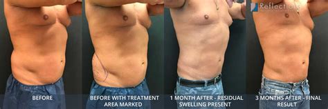 Love Handles Removal Surgery
