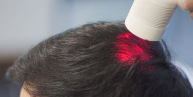 Low-Level Laser Therapy for Male Pattern Baldness