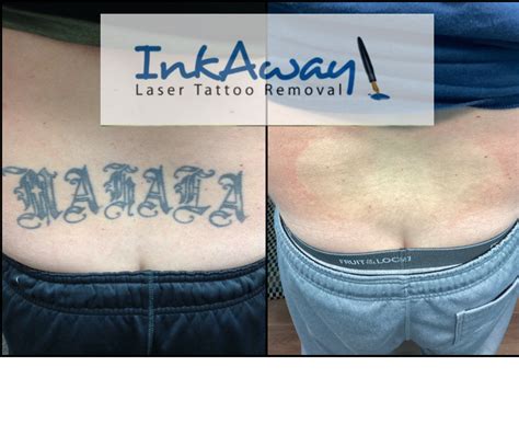 Laser Tattoo Removal lower back YouTube