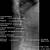 Lumbar Spine Anatomy Xray