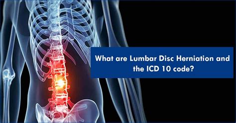 Lumbar Disc Disorder Icd 10