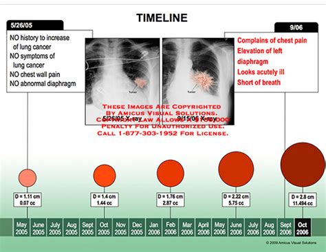 Diagram showing lung cancer stages 301312 Vector Art at Vecteezy