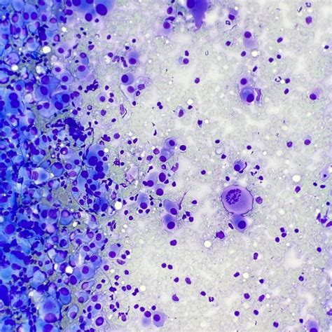 Lymph Node FNA Test and interpretation