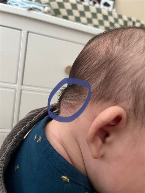 Unlocking the Mystery of Baby's Lymph Node on the Occiput: Causes, Symptoms, and Treatment.